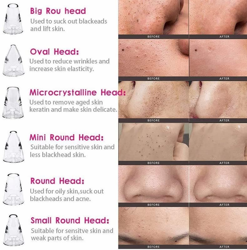 ⭐ DermaGlow™ 5-in-1 Acne & Blackhead Remover Pro Glower Steps