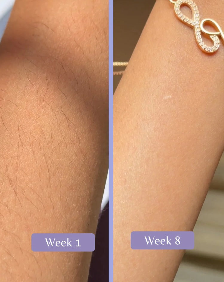 IPL Hair Removal Handset 🌸 Glower Steps